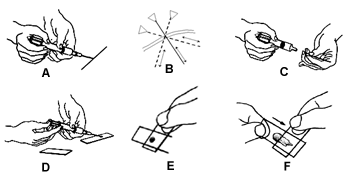 Fig. 1. Técnica de punção aspirativa por agulha fina: uma agulha de 30x7 ou 30x8mm acoplada a uma seringa é introduzida na massa e é aplicada uma pressão negativa (A); a agulha é movimentada em direções diferentes dentro da massa para obter uma amostra representativa (B); a pressão negativa é desfeita, a agulha é retirada e destacada da seringa (C). A seguir (D a F) são feitos esfregaços imediatamente (de Ménard et al., 1986). 